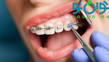 درمان پوسیدگی دندان در ارتودنسی-03